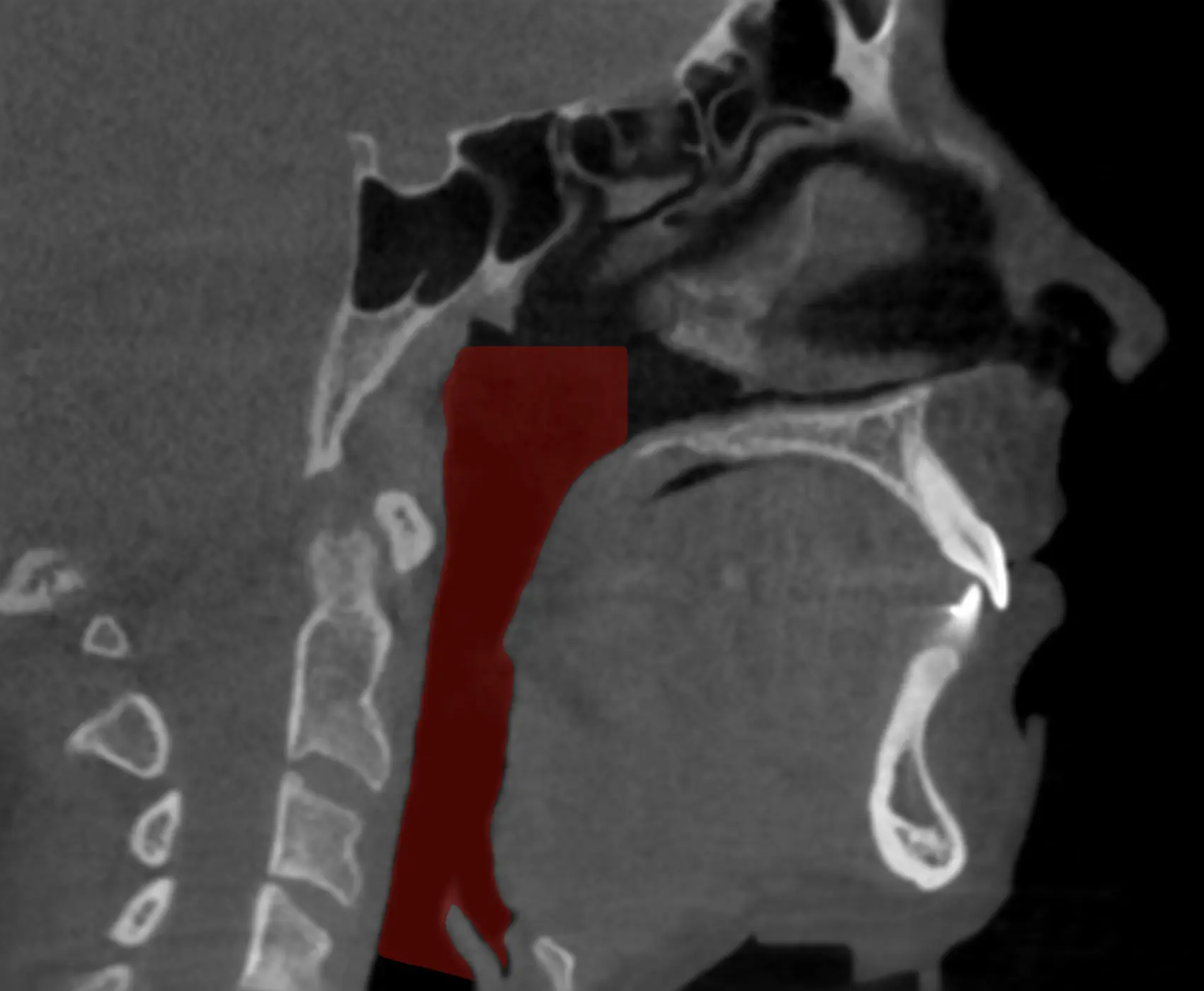 Sleep Apnea Overview Image 2
