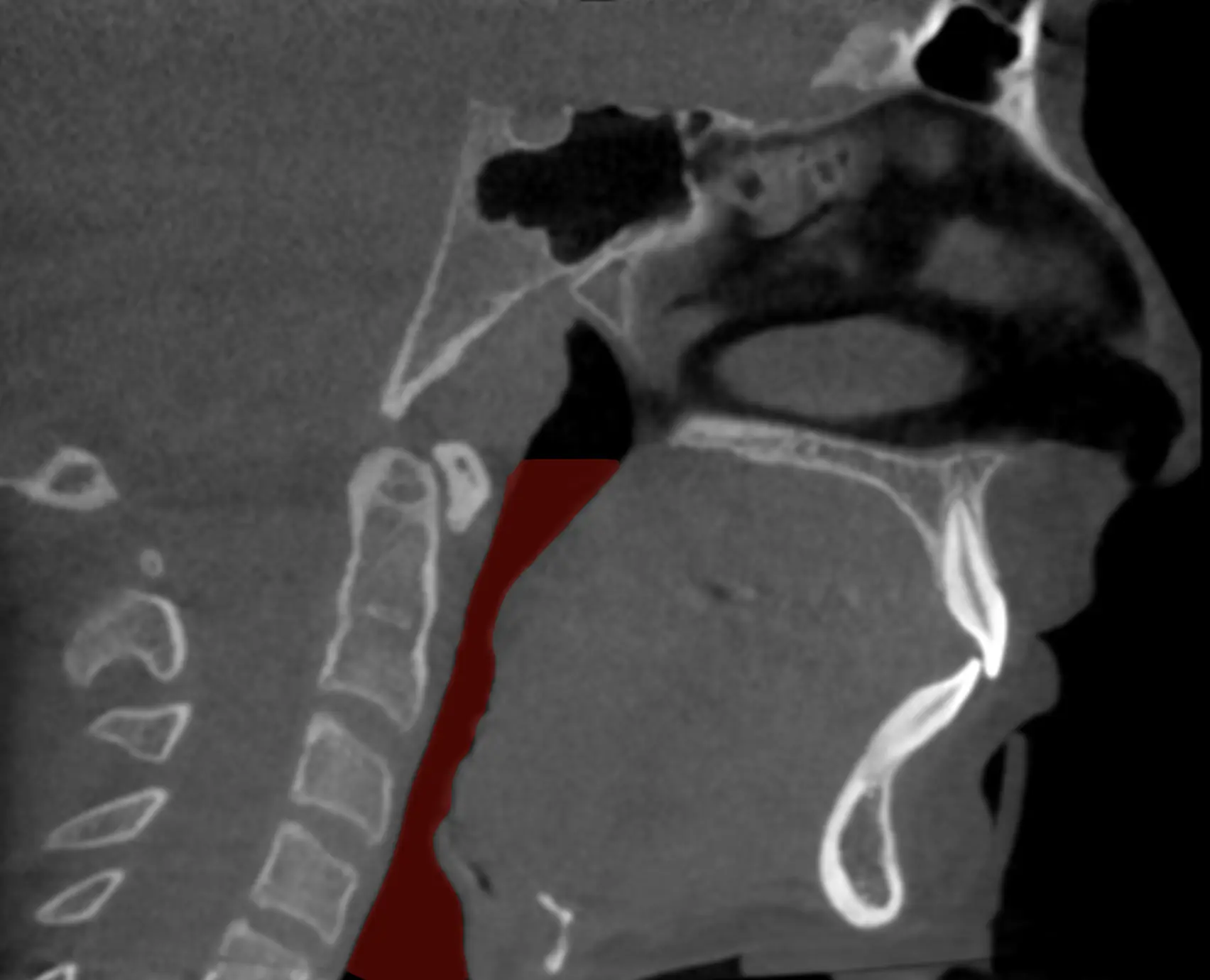 Sleep Apnea Overview Image
