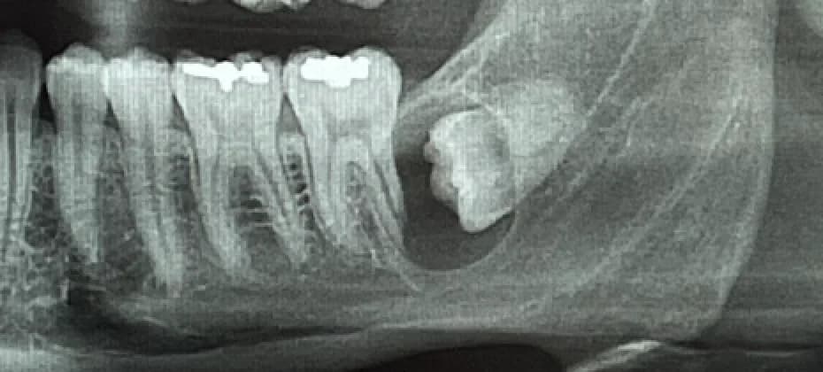 Extraction des dents de sagesse Image 2
