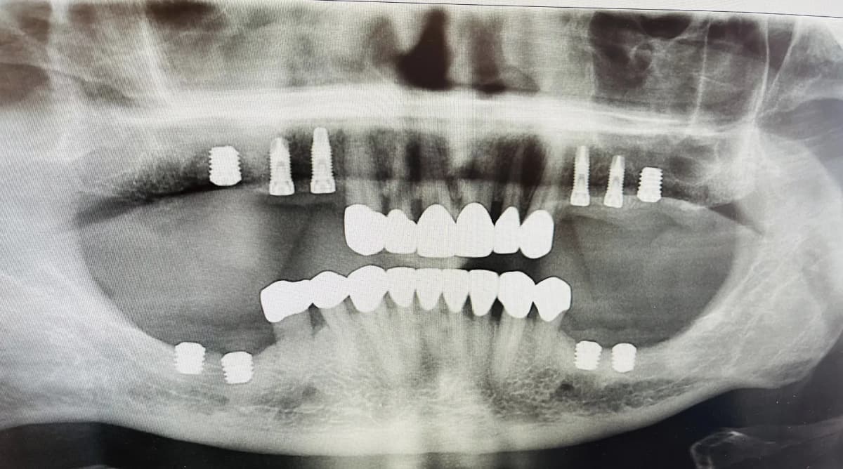 Dental Implant Surgery Overview Image