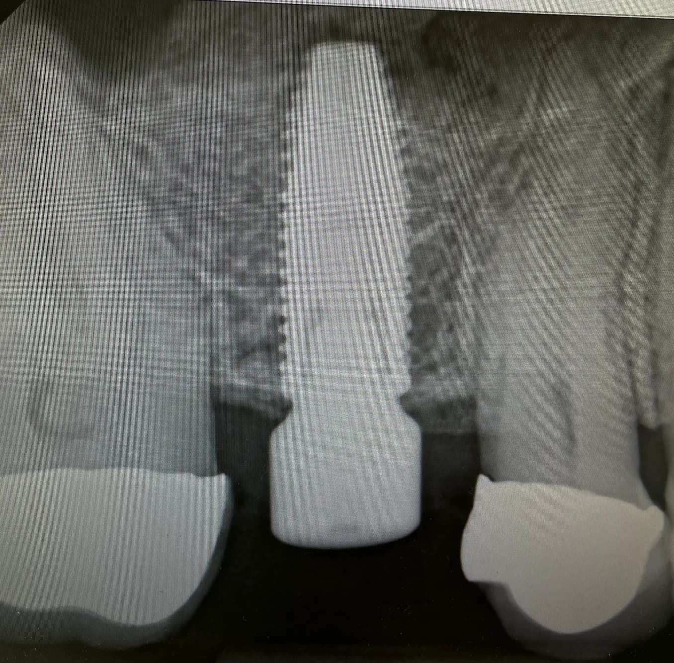 Dental Implant Surgery Benefits Image 2