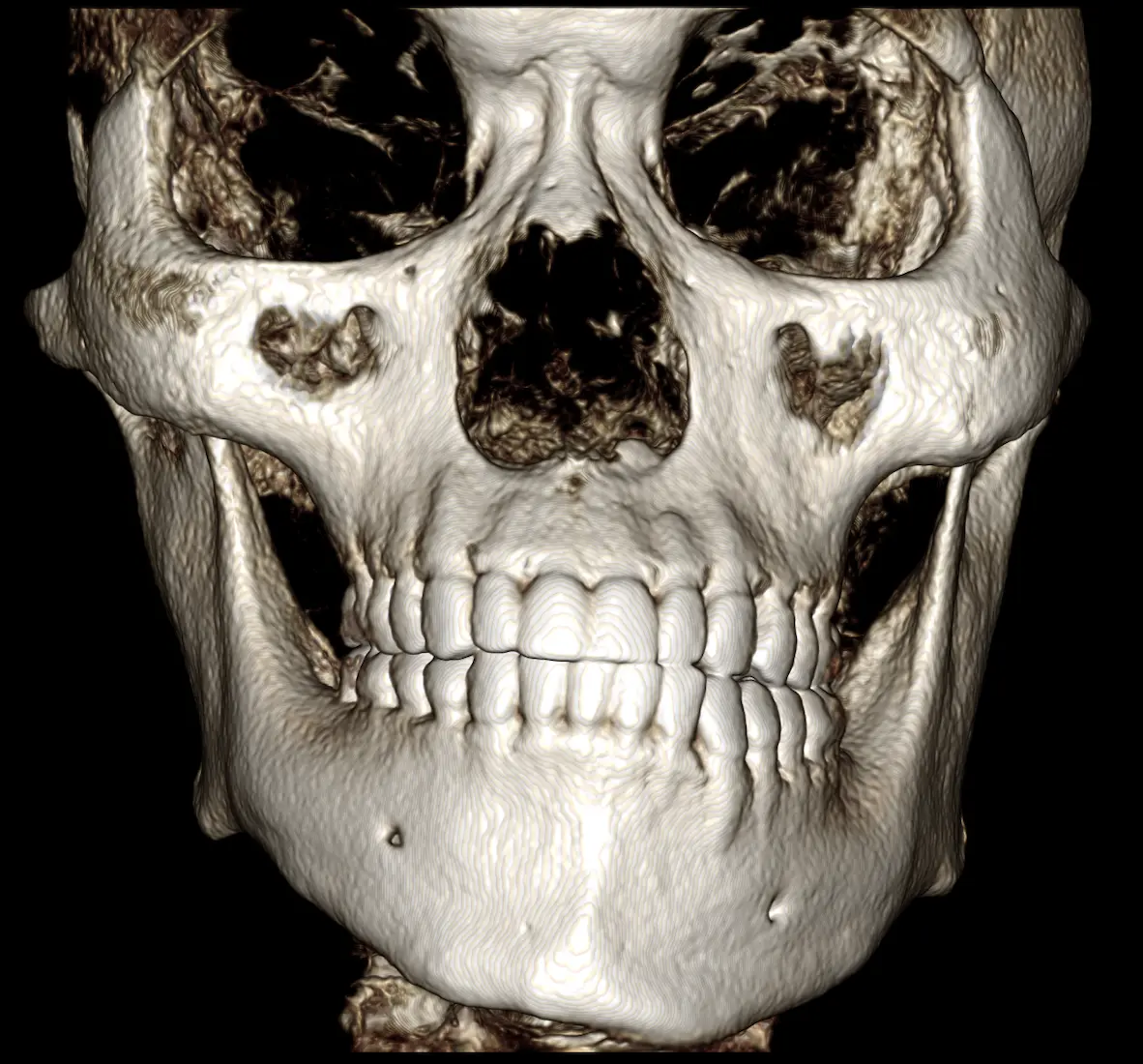 Image d’aperçu de chirurgie orthognathique