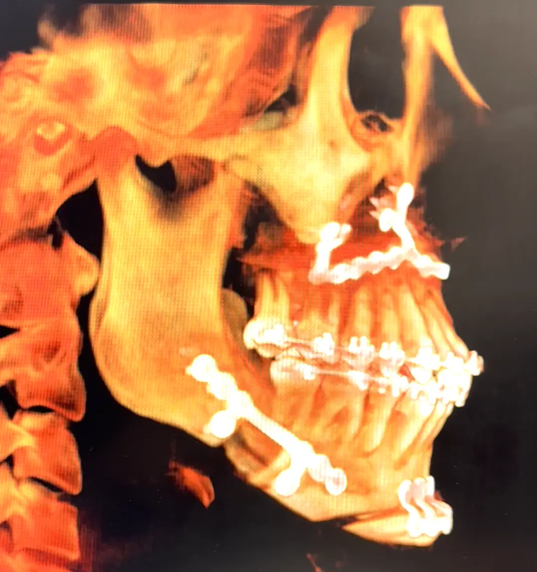 Chirurgie Orthognathique Image 2
