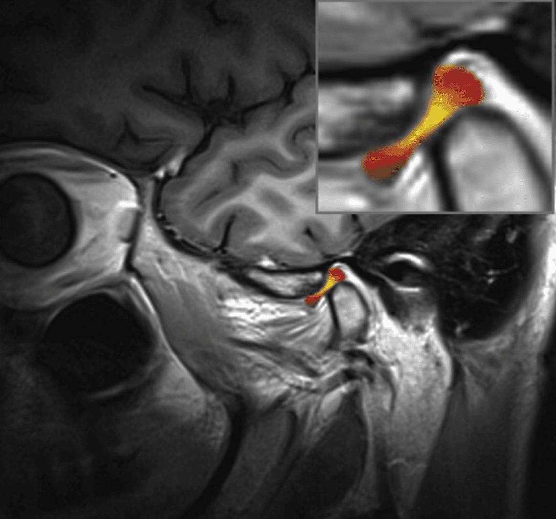 Image d’aperçu des troubles de l'ATM