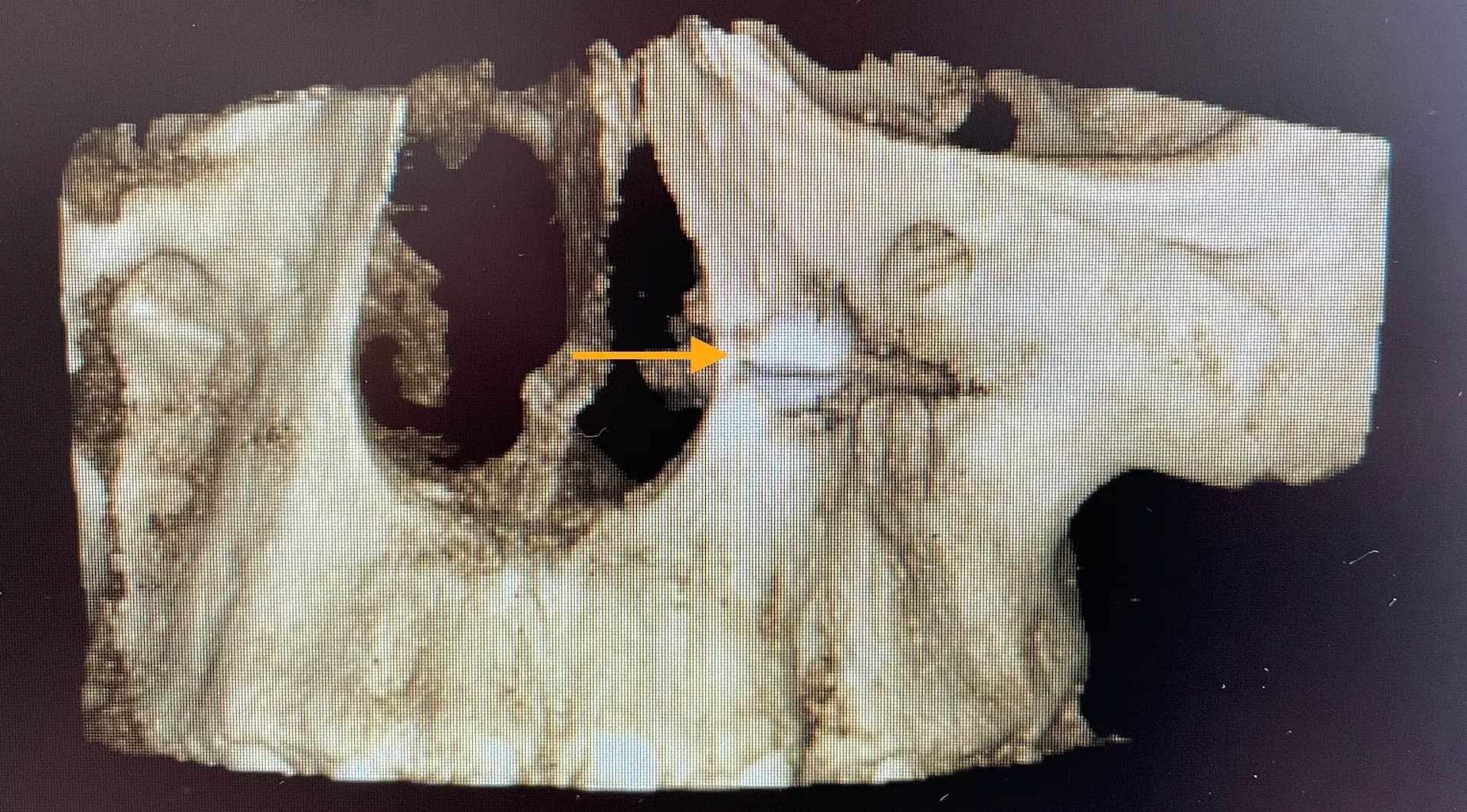 Tooth Exposure Overview Image