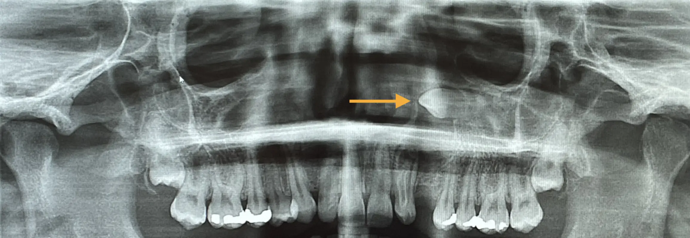 Tooth Exposure Overview Image 2