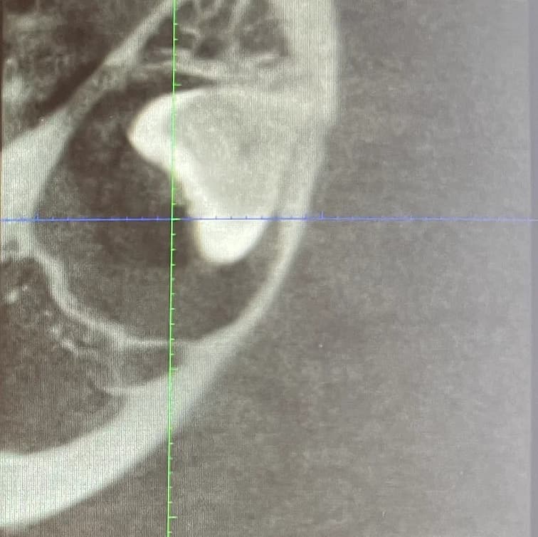 Extraction des dents de sagesse Image 3