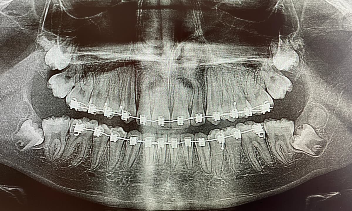 Image d’aperçu d’extraction des dents de sagesse